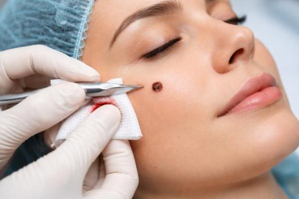 Bolehkah Menghilangkan Tahi Lalat yang Membesar?